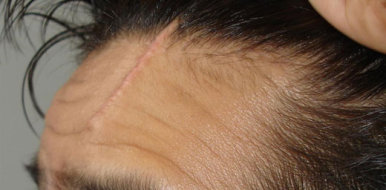 Шрам на голове: особенности заживления и способы маскировки