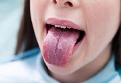 Лечение ранки на языке: медикаментозное и нетрадиционное