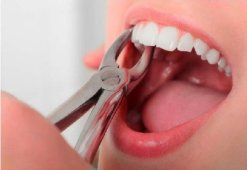 Как ухаживать за раной после извлечения зуба: полоскание и обработка