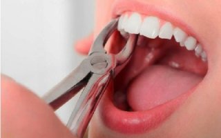 Как ухаживать за раной после извлечения зуба: полоскание и обработка