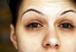 Химический ожог глаза: симптомы, первая помощь и последующее лечение