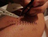 Как обрабатывать рану после снятия швов: обзор мазей и растворов