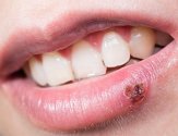 Что делать, если появляются ранки на губе и болят: особенности лечения