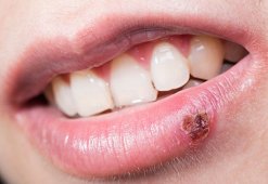 Что делать, если появляются ранки на губе и болят: особенности лечения