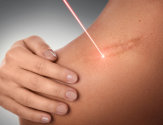 Как быстро убрать шрамы от порезов при помощи аппаратных методик и косметических процедур