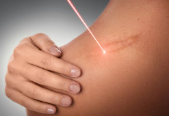 Как быстро убрать шрамы от порезов при помощи аппаратных методик и косметических процедур