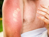 Как и чем лечить солнечные ожоги кожи в домашних условиях