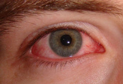 Ожог глаз: виды повреждения и методы лечения