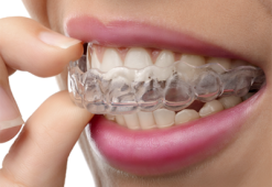 Лечение зубов без брекетов: как проводится терапия элайнерами