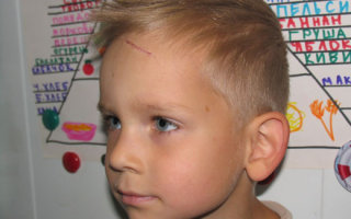 Обзор эффективных методов избавления от шрамов у детей на лице и теле