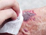 Почему из повреждения на коже выделяется жидкость: опасность мокнущей раны