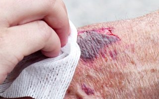 Почему из повреждения на коже выделяется жидкость: опасность мокнущей раны
