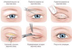 Осложнения после блефаропластики – какие бывают и как избежать