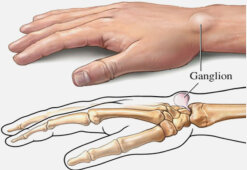Образование шишек и наростов на пальцах рук: причины, симптомы и лечение