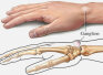 Образование шишек и наростов на пальцах рук: причины, симптомы и лечение