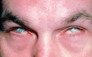 Ожог роговицы (слизистой) глаза: признаки, первая помощь и лечение