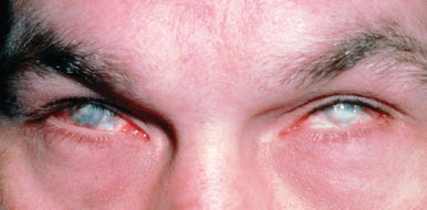 Ожог роговицы (слизистой) глаза: признаки, первая помощь и лечение