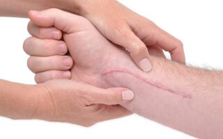 Как можно быстро убрать шрамы от порезов на руке