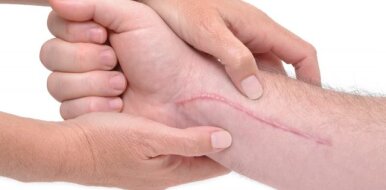 Как можно быстро убрать шрамы от порезов на руке
