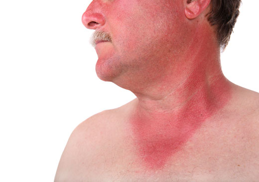 солнечный ожог на лице у мужчины